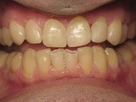 Composite Fillings — Case 2 after treatment