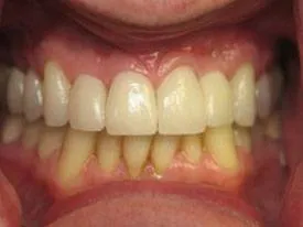 Implant Dentistry after treatment