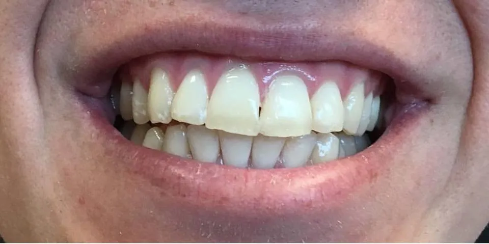 Aesthetic Trimming & Whitening before treatment